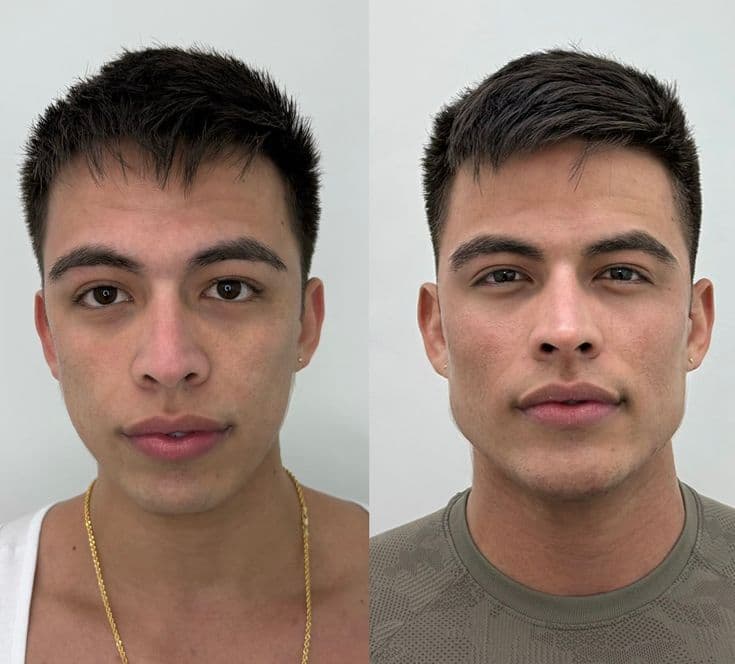Weak jawline to Defined structure