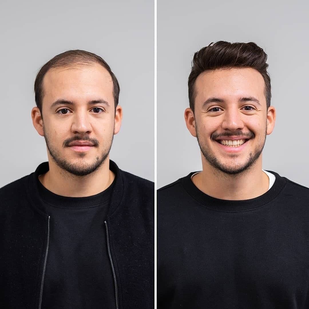 Hair Loss Prevention for Men: What Actually Helps